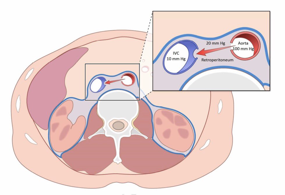 DrSethdb's tweet image. #Transcaval experience n=100
#TCT2016
&amp;gt;Gr8 translational project from @nih_nhlbi to @HenryFordNews
@JACCJournals
content.onlinejacc.org/data/Journals/…