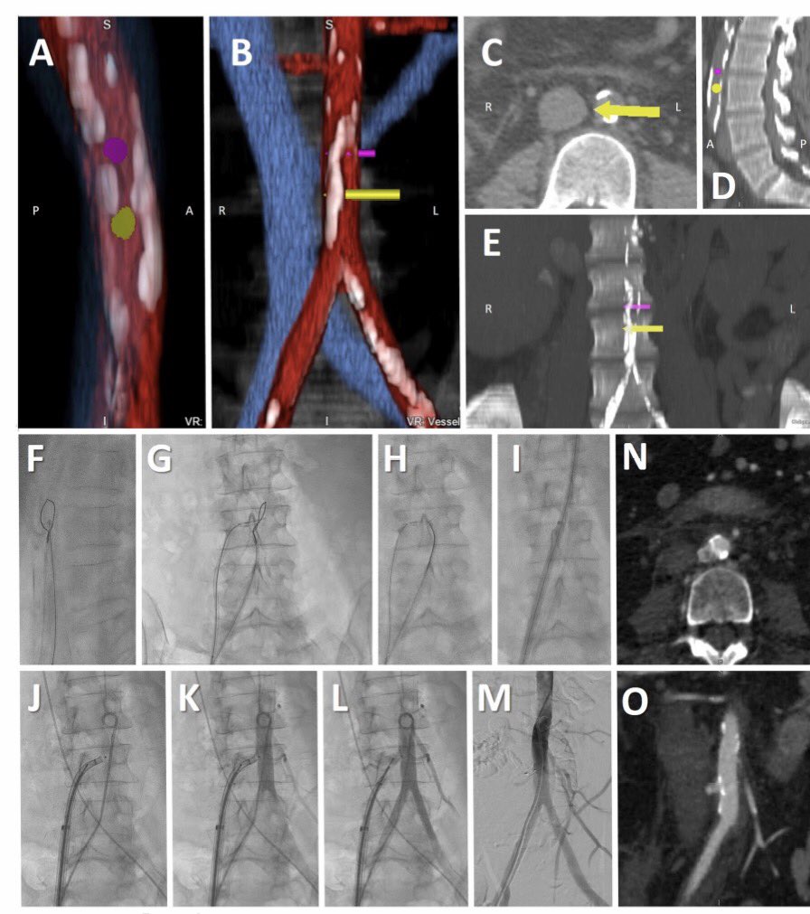 DrSethdb's tweet image. #Transcaval experience n=100
#TCT2016
&amp;gt;Gr8 translational project from @nih_nhlbi to @HenryFordNews
@JACCJournals
content.onlinejacc.org/data/Journals/…