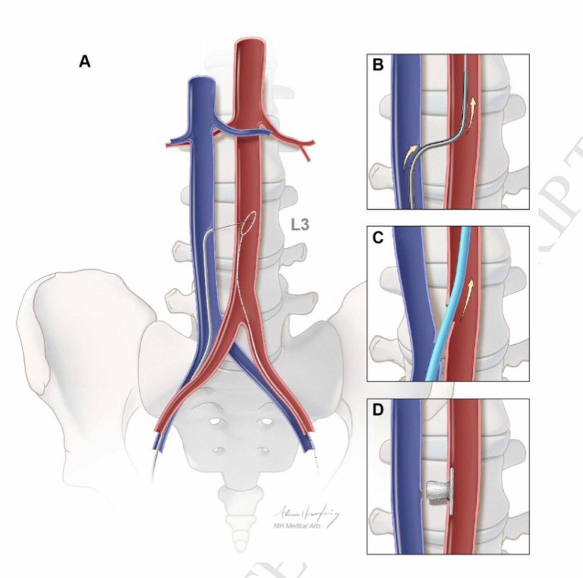 DrSethdb's tweet image. #Transcaval experience n=100
#TCT2016
&amp;gt;Gr8 translational project from @nih_nhlbi to @HenryFordNews
@JACCJournals
content.onlinejacc.org/data/Journals/…
