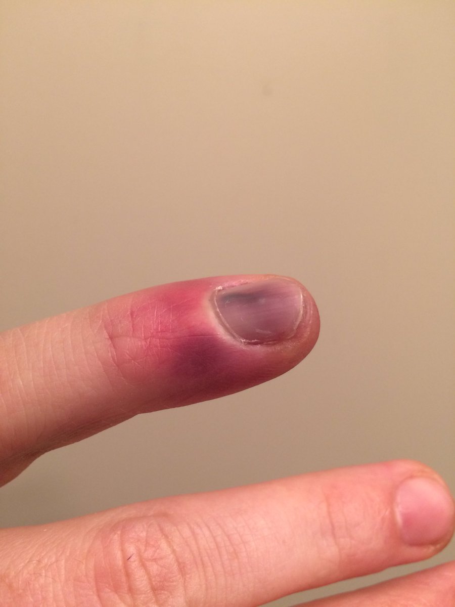 corn_cwm's tweet photo. #FingerWatch Day 3: The nail is turning all sorts of colours it shouldn't be. Also noticed bruising up near the webbing. https://t.co/Z3M7OXv9tF