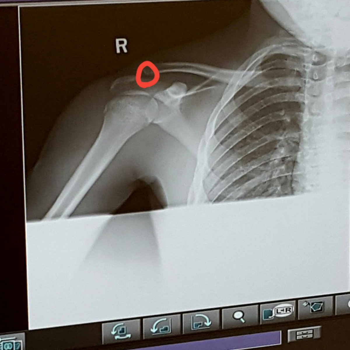 _plug55's tweet image. 1 more week before my shoulder finish healing,didn't realize how fast my shoulder was healing👌💪❕💯