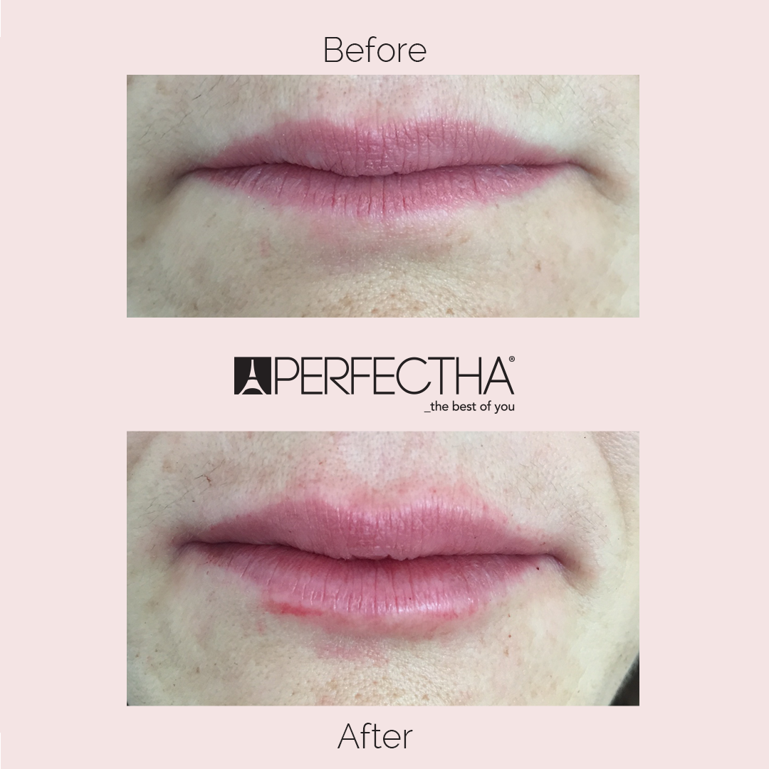 PerfecthaGlobal's tweet photo. Check out this beautiful and natural looking #PERFECTHApout by @skinfinityuk
using 1ml of PERFECTHA Derm #Perfectpout #partylips #Partypout https://t.co/HmrNC8nFri