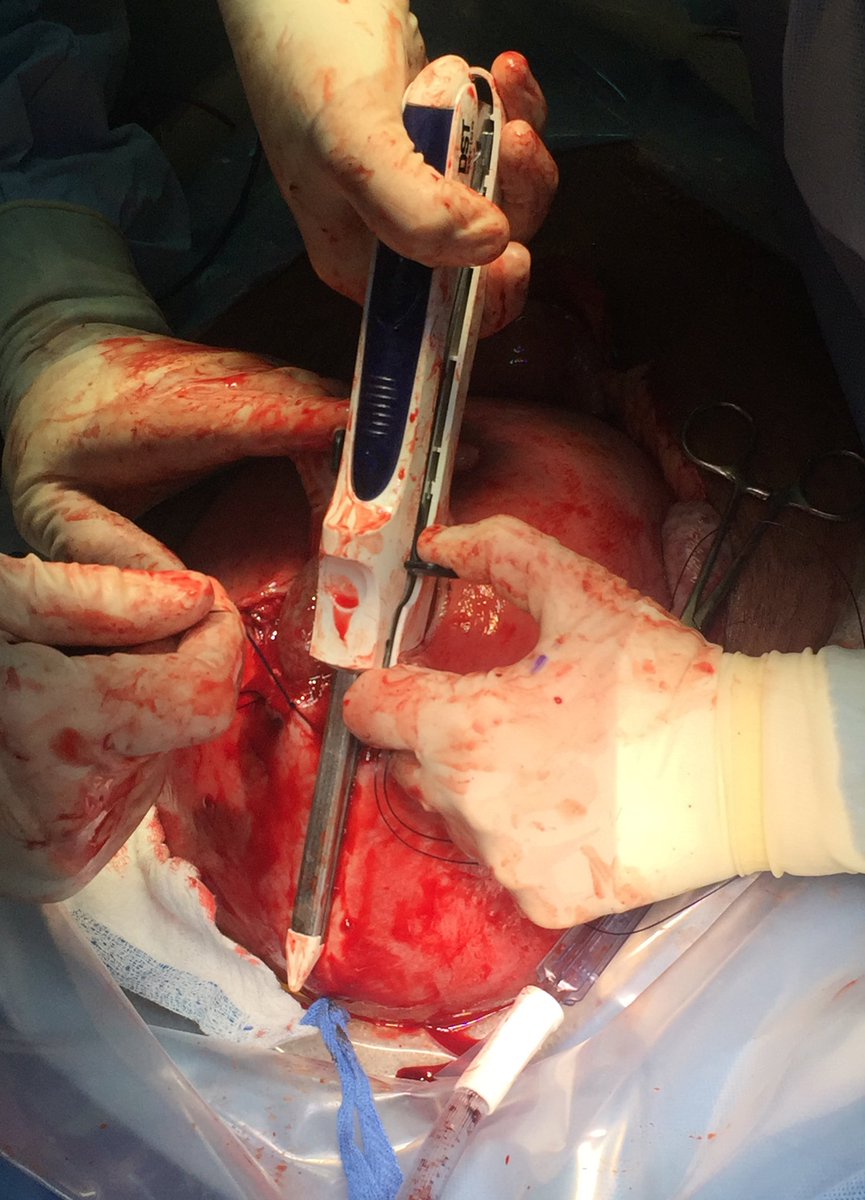 AJOG_thegray's tweet photo. Minimizing blood loss at #cesarean-#hysterectomy for placenta previa percreta - https://t.co/VP8h1sz5Tx https://t.co/cOoS7QRMvH