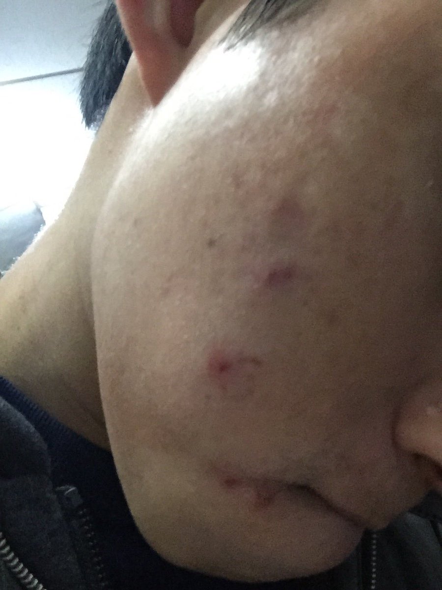 Acabo de aniquilar BRUTALMENTE 3 espinillas en mi rostro.... SOY UN ASESINO 😈😈