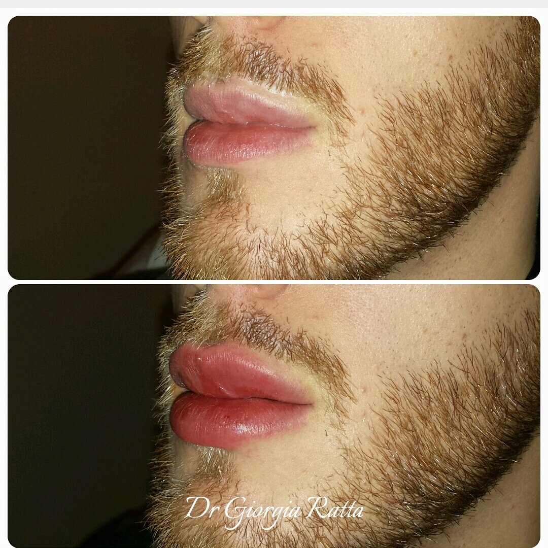 drGiorgiaRatta's tweet photo. @PerfecthaUK
#partylip #Perfectha #perfectlip #perfectpout #menfillers https://t.co/CTmtx7mHYp