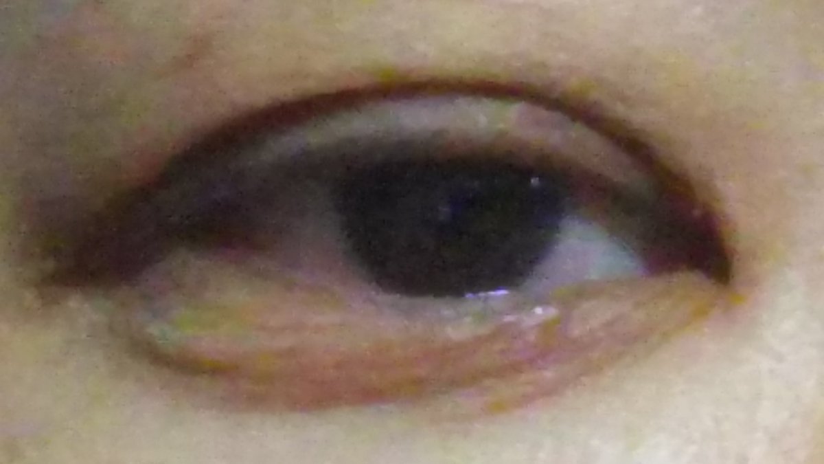 Mam A Twitter 何のアレルギーかわからないのですが 充血とめやにがすごい 朝目が開かない 笑 目がかゆーーーーい 花粉系だと嫌ダナー
