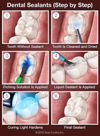 Dental sealants are recognized as an effective approach to preventing pit and fissure cavities in children and teens.