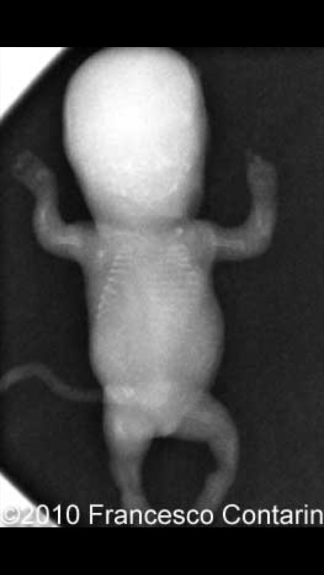 endoretic16's tweet photo. The Golgi Apparatus causes Achondrogenesis. A vote for the Golgi Apparatus is a vote for malformed babies Vote ER #cellection16 https://t.co/WvOmURy4oX