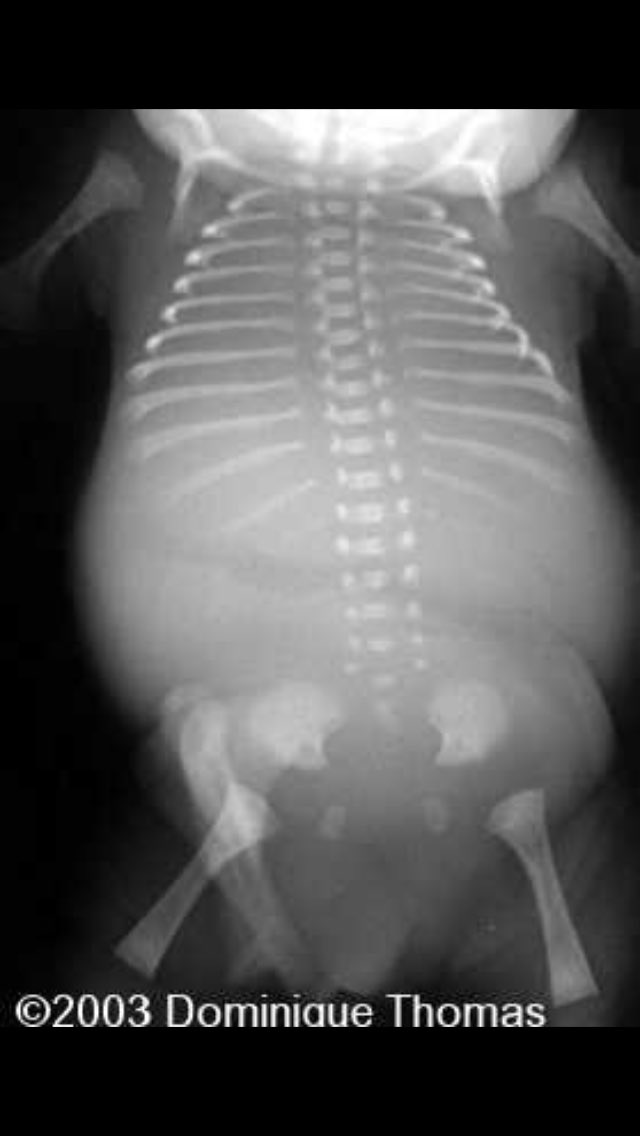 endoretic16's tweet photo. The Golgi Apparatus causes Achondrogenesis. A vote for the Golgi Apparatus is a vote for malformed babies Vote ER #cellection16 https://t.co/WvOmURy4oX