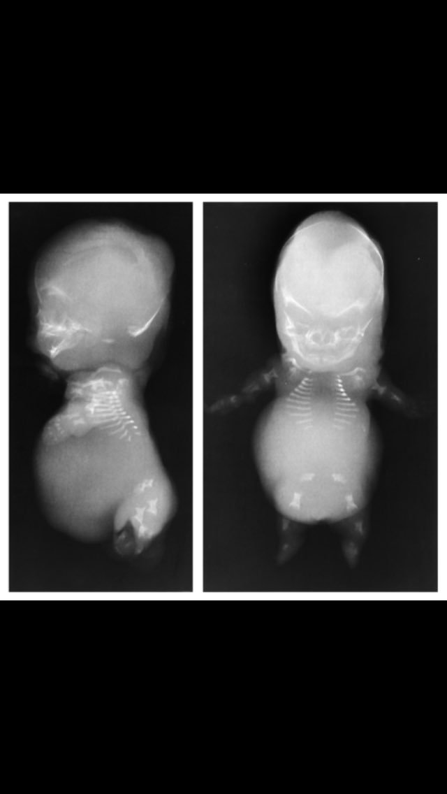endoretic16's tweet photo. The Golgi Apparatus causes Achondrogenesis. A vote for the Golgi Apparatus is a vote for malformed babies Vote ER #cellection16 https://t.co/WvOmURy4oX