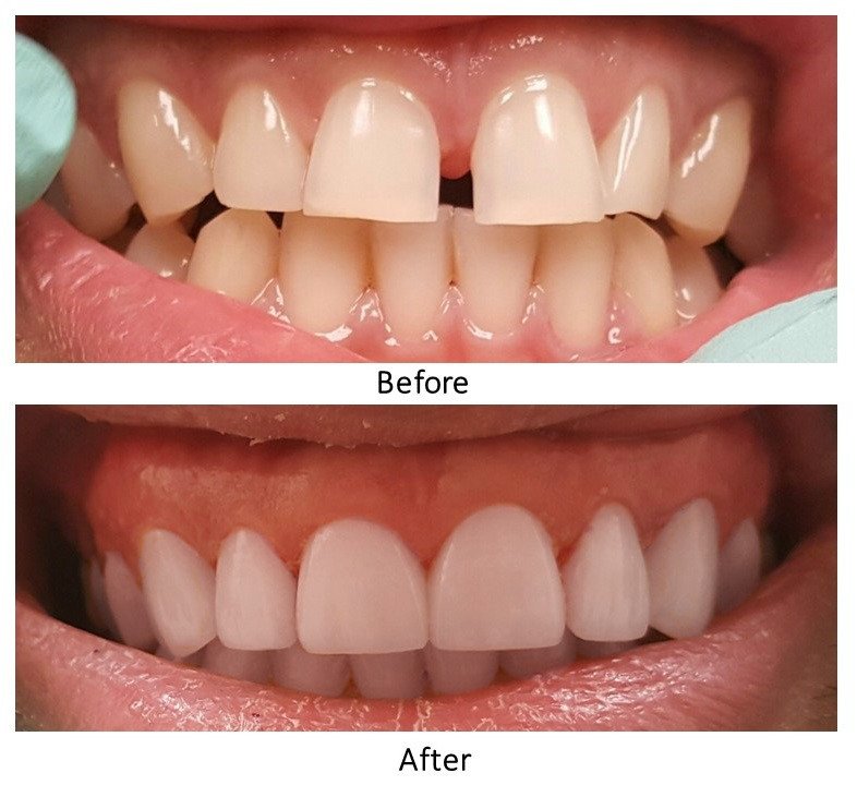 The radiant smile of your dreams! Call (281)492-1111 to schedule your appointment! 
*Photo is that of a satisfied Katy Star Dental patient.*