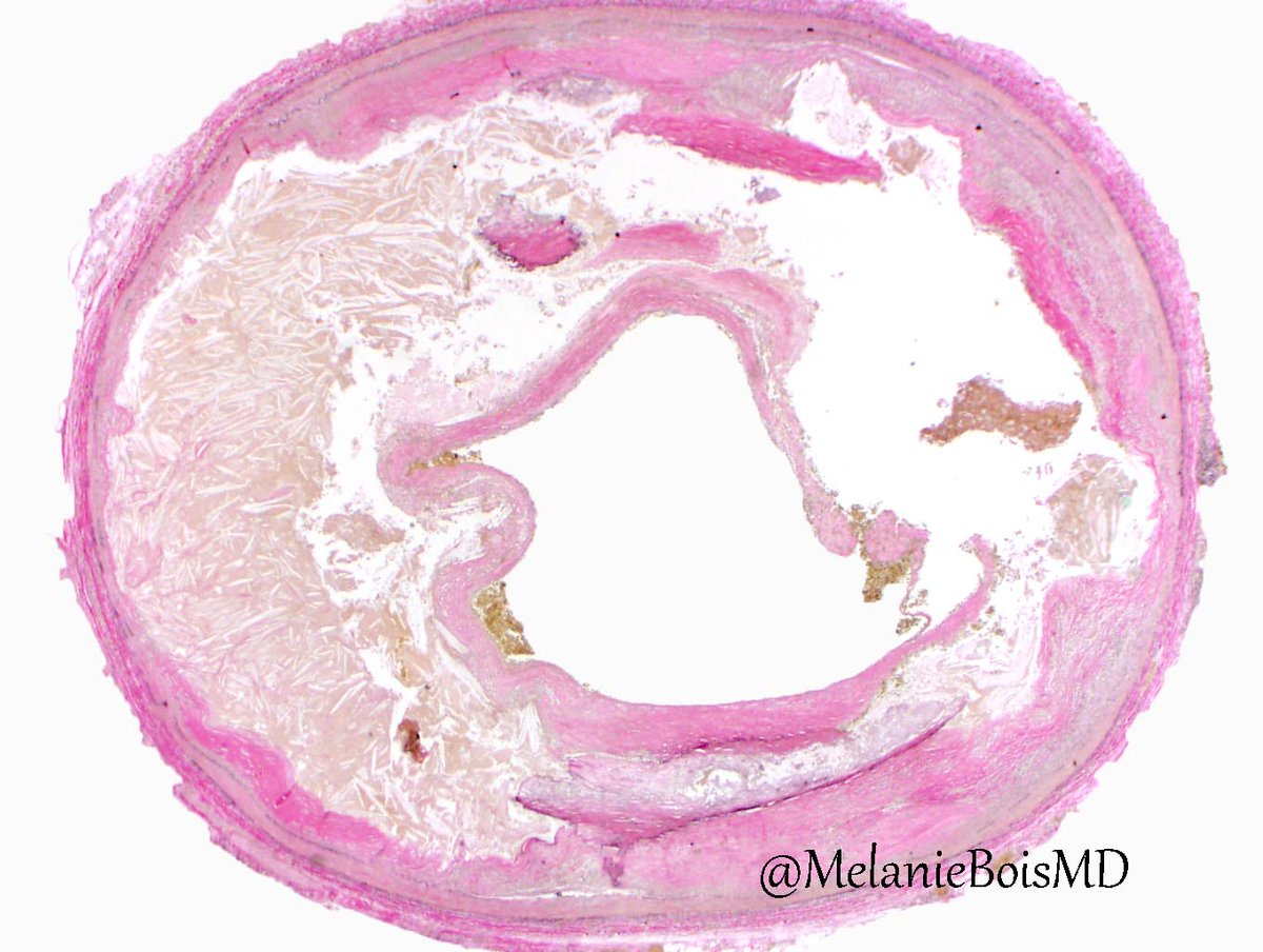 MelanieBoisMD's tweet photo. Pathology of vulnerable plaque: Necrotic core (with cholesterol clefts) & thin fibrous cap https://t.co/OdntQX1qUh #MayoCVPath #CardiacPath https://t.co/li74CBZwDK