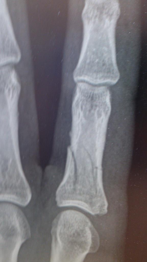 #bbcsportsday fractured finger in two places playing hockey. Still scored but my hand was like a balloon after!