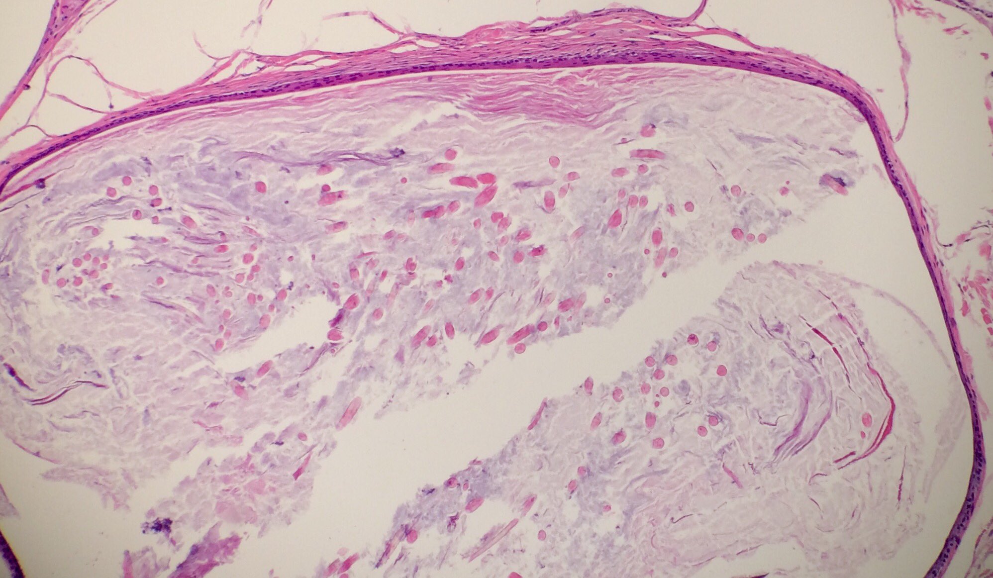 James A Ramirez On Twitter Vellus Hair Cyst More Fun With