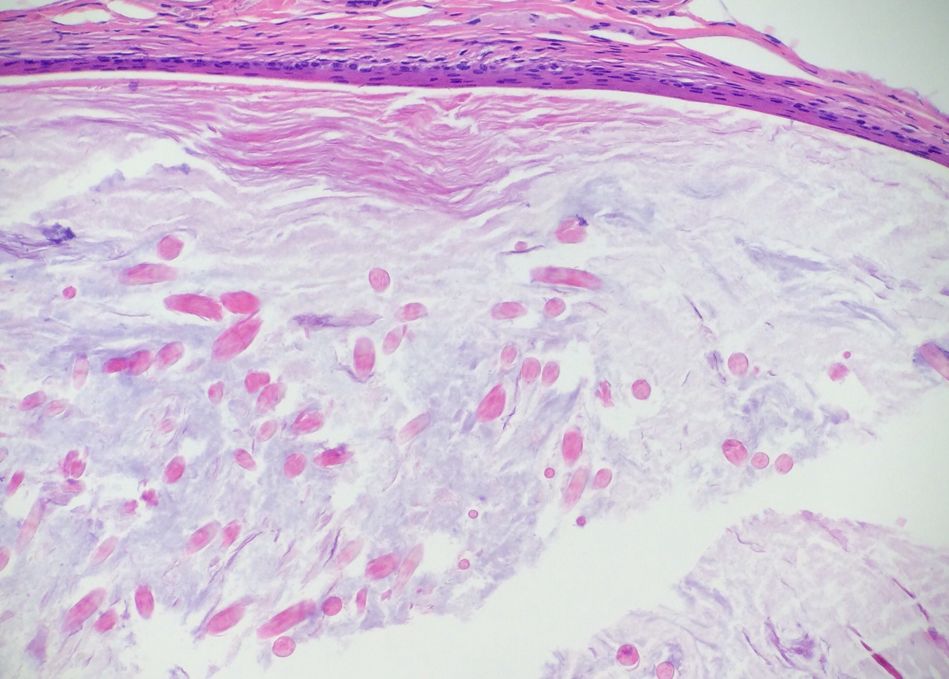 James A Ramirez On Twitter Vellus Hair Cyst More Fun With