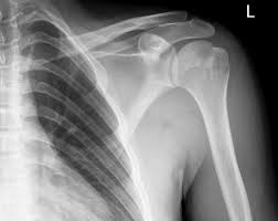 Shoulderfolder's tweet photo. This is what your radiologist sees #dislocatedshoulder #heretohelp https://t.co/ML5yp87mXZ