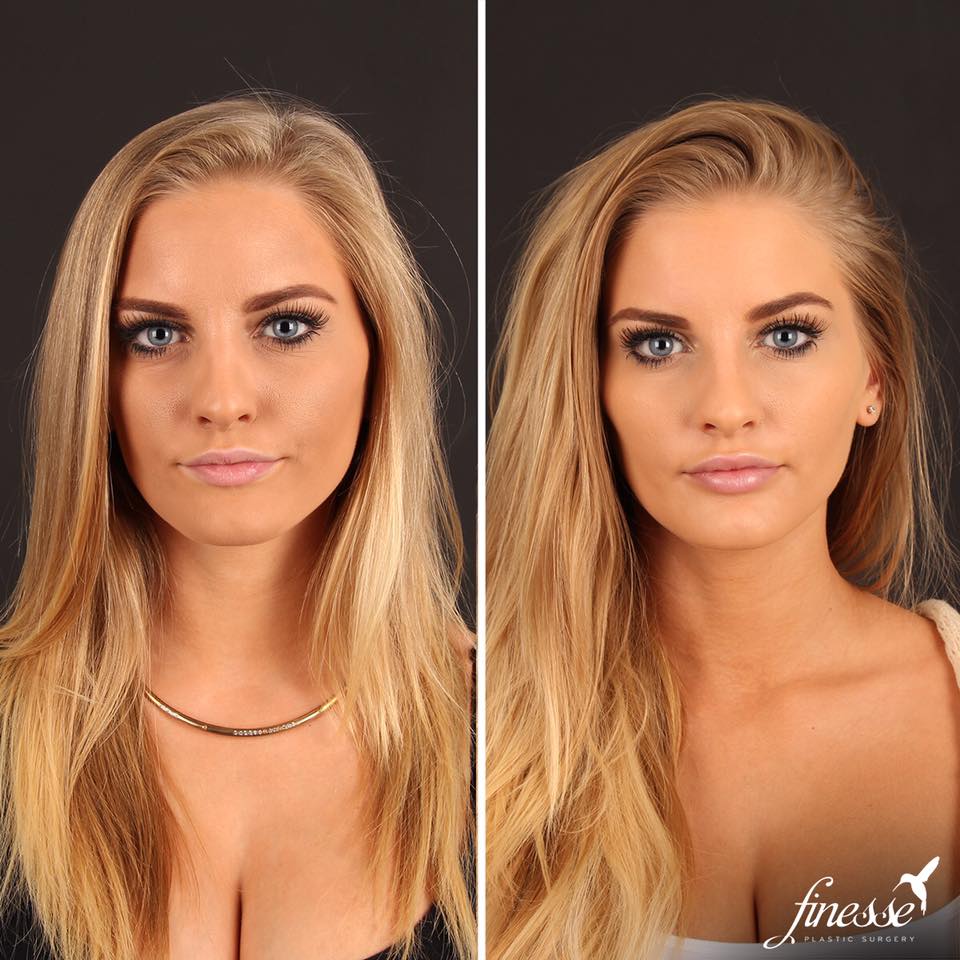 FinessePS's tweet photo. Because luscious lips are in!
Before/After - 1 syringe of Juvederm Ultra
Photo taken 2 weeks post treatment.
#LipAug #LipFiller #Lips https://t.co/ww9co7jUVp