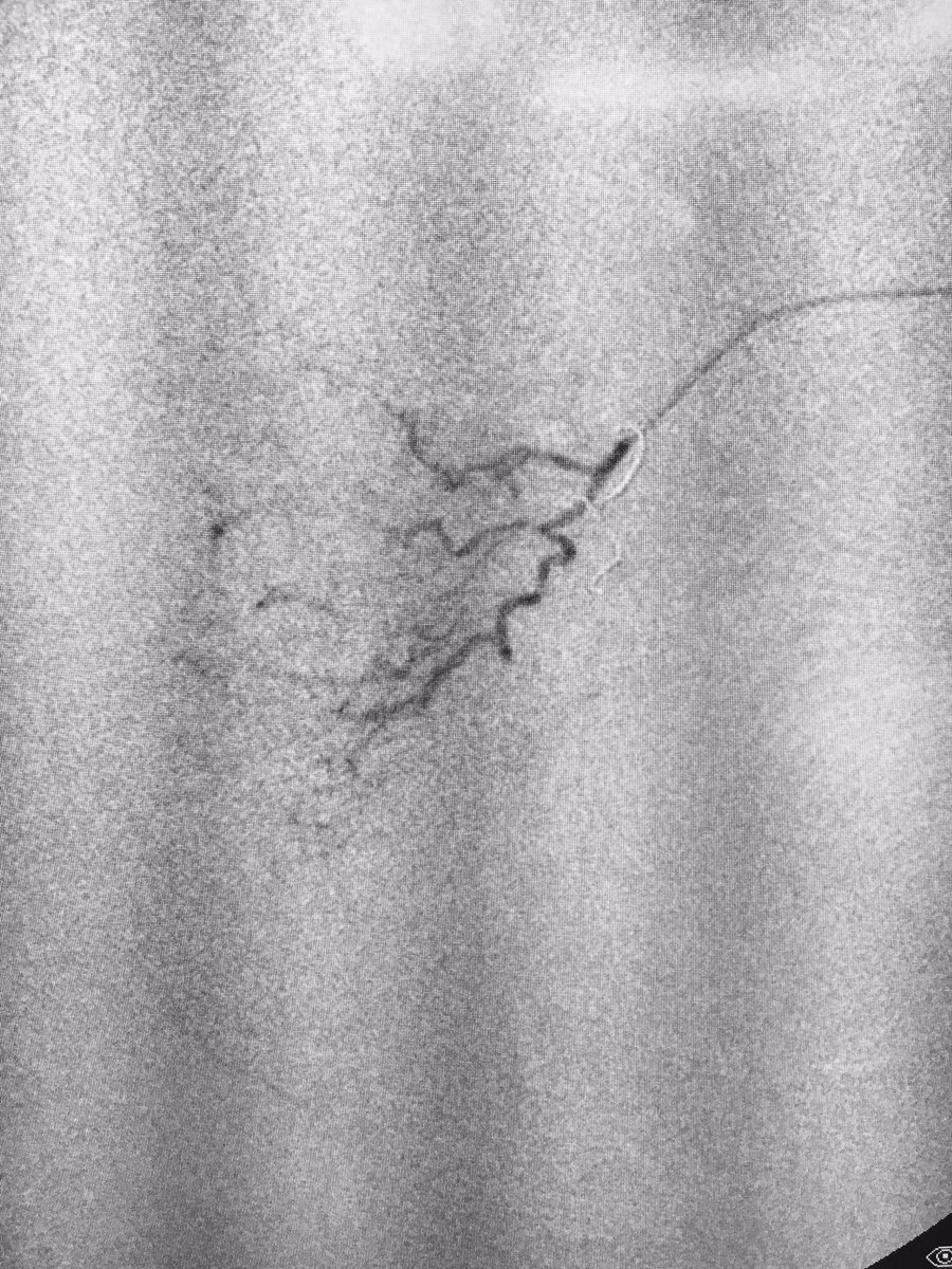 live #pae @Team_VIV. Coil rectal (ima inflow) and get distal. Obturator branches to PA and rectum. @MountSinaiIR @AriIsaacsonMD @SIRRFS