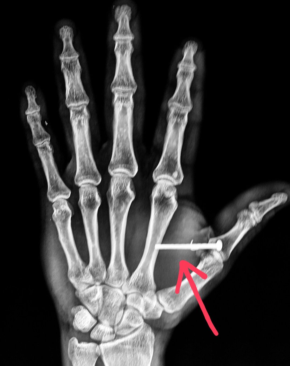 steleRAD's tweet photo. #Xray shows a #nail in the #hand from a nail #gun.
#radiologist #radiology #trauma #pain #injury #nailgun https://t.co/RmuMmkt7co