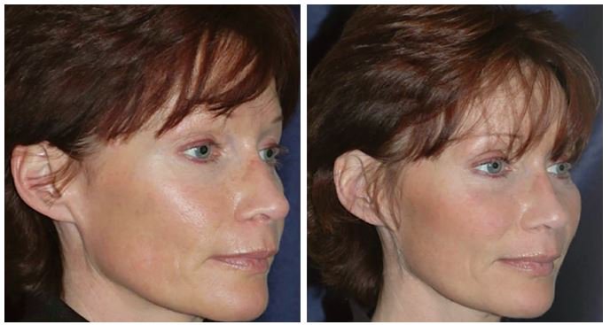 UCLAHealth's tweet image. #Endotine implants only use a 1-2 cm small portion of a normal #facelift scar #UCLAMDCHAT ➨  facebook.com/uclahealth