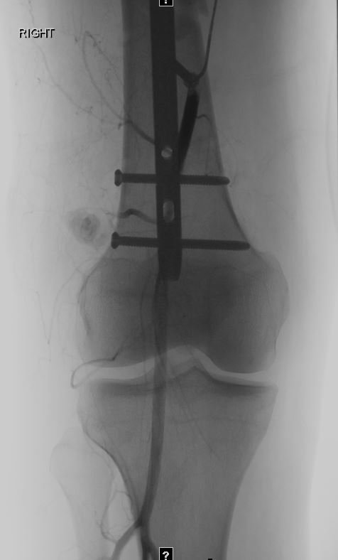 kmadass's tweet photo. Traumatic PSA lurking behind gnarly hardware. #irad #irush #withoutascalpel Funtimes with @sonijayeshm @ozenmerveMD @VIR_RUSH https://t.co/a2orq2VRI3