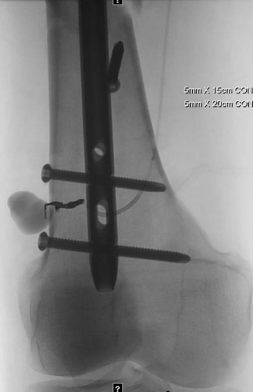 kmadass's tweet photo. Traumatic PSA lurking behind gnarly hardware. #irad #irush #withoutascalpel Funtimes with @sonijayeshm @ozenmerveMD @VIR_RUSH https://t.co/a2orq2VRI3