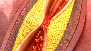 VeinExpertsATL's tweet photo. Clogged #arteries: Signs and #symptoms of arterial plaque https://t.co/t7ySiCm7Dl by @belmarra https://t.co/flokQjnozr