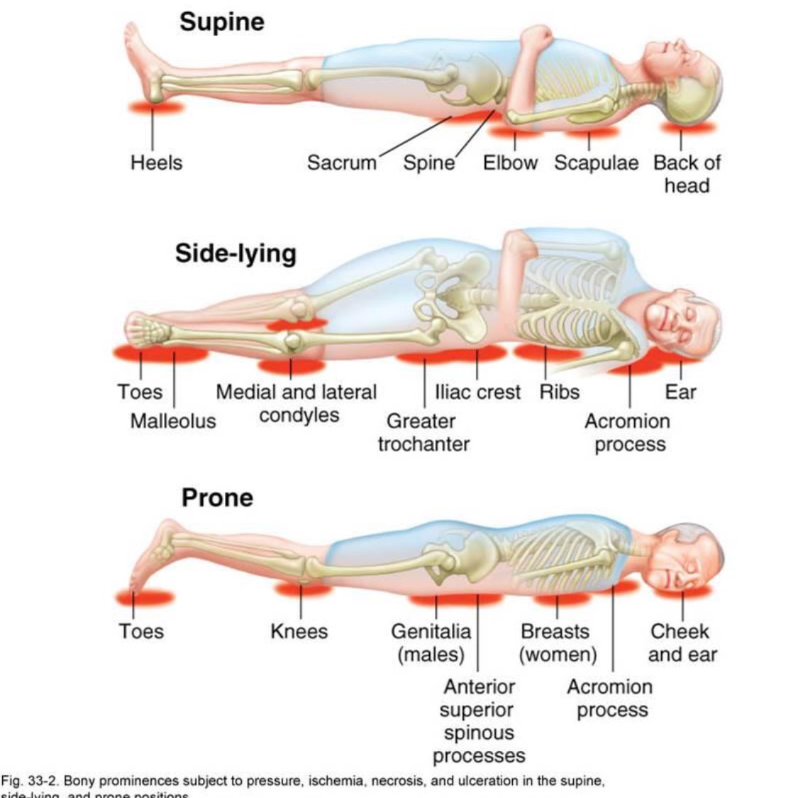 Vicky0Foster's tweet image. @CWPT_TVN Day 4 #stopthepressure #skininspection #looklistenfeel for skin changes inc colour, temp, pain / sensation, tissue consistency