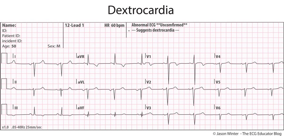 зубец u на экг. экг при декстрокардии наложение электродов. наложение электродов при экг декстракардии. декстрокардия на экг. декстрокардия на экг.