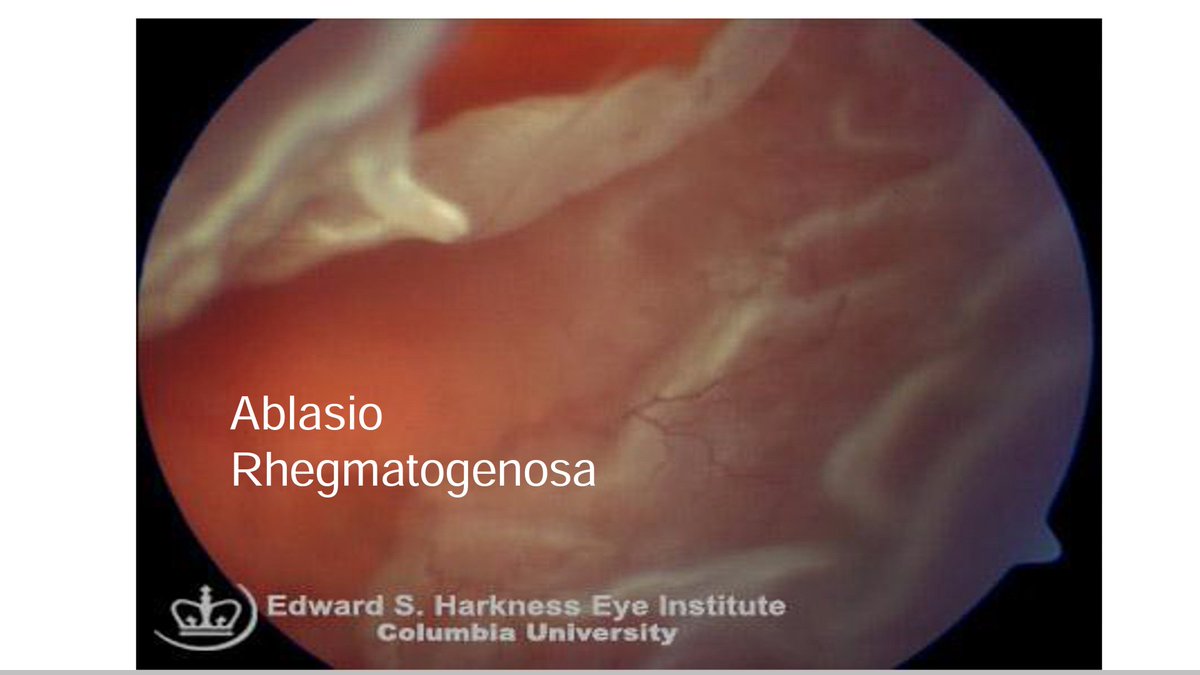 Ablasio retina rhegmatogenosa: robekan pd lap. neuronal menyebabkan cairan vitreus masuk ke antara retina sensorik dgn epitel pigmen retina.