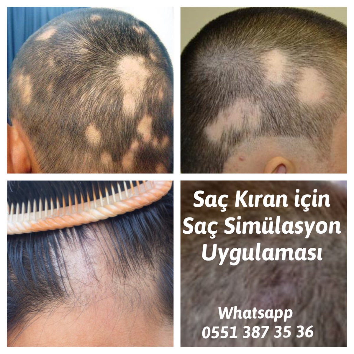 mikroblading's tweet image. Saç simülasyon ile Saç Kıran Kellik Tedavisi mümkün Bilgi için iletişime geçiniz