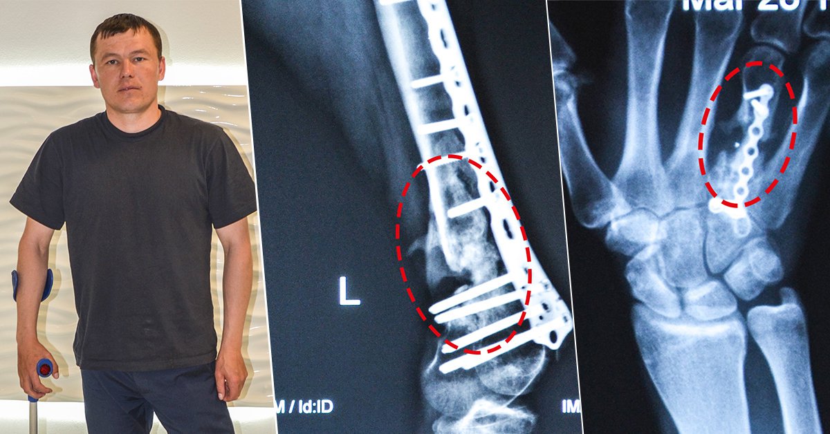 5channel's tweet image. Поранений під Кримським боєць потребує допомоги bit.ly/2fX5lt8