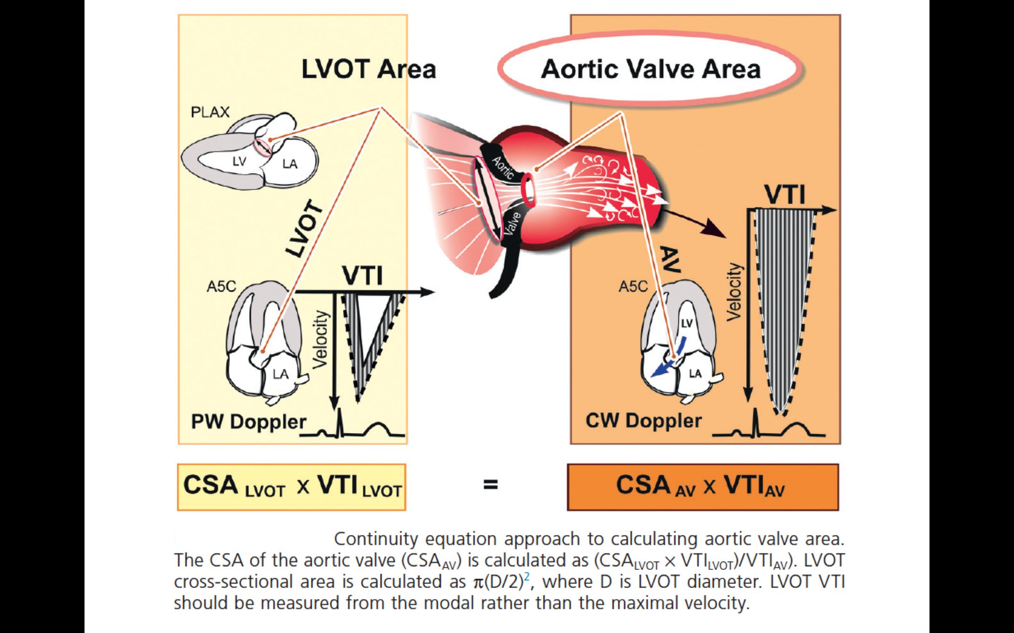 Edgardo Alania On Twitter Continuity Equation Approach To Edgardo Alania On Twitter Continuity Equation Approach To Calculating Aortic Valve Area Cardiology Foamed Cardioed Echocardio Https T Co Y3dzxpq6uo