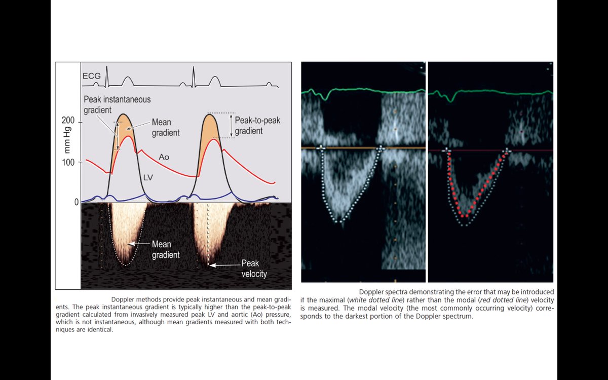 Edgardo Alania On Twitter Continuity Equation Approach To Edgardo Alania On Twitter Continuity Equation Approach To Calculating Aortic Valve Area Cardiology Foamed Cardioed Echocardio Https T Co Y3dzxpq6uo