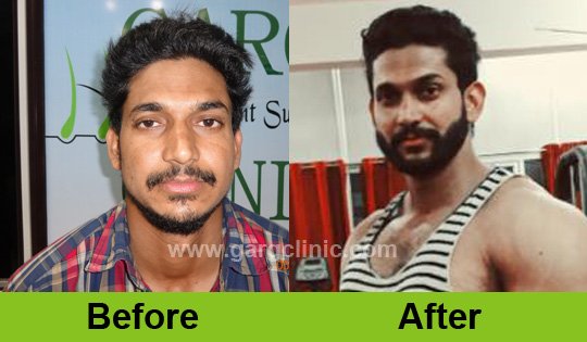 Garg Hair Clinic (@GargClinic) / Twitter Garg Hair Clinic (@GargClinic) / Twitter