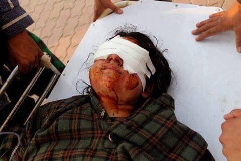 NadeemfParacha's tweet photo. 13-year-old Ifra shot in the eyes with pellets by Indian forces in Kashmir. Monsters! #KashmirIntifada https://t.co/F0BqwyeDKT