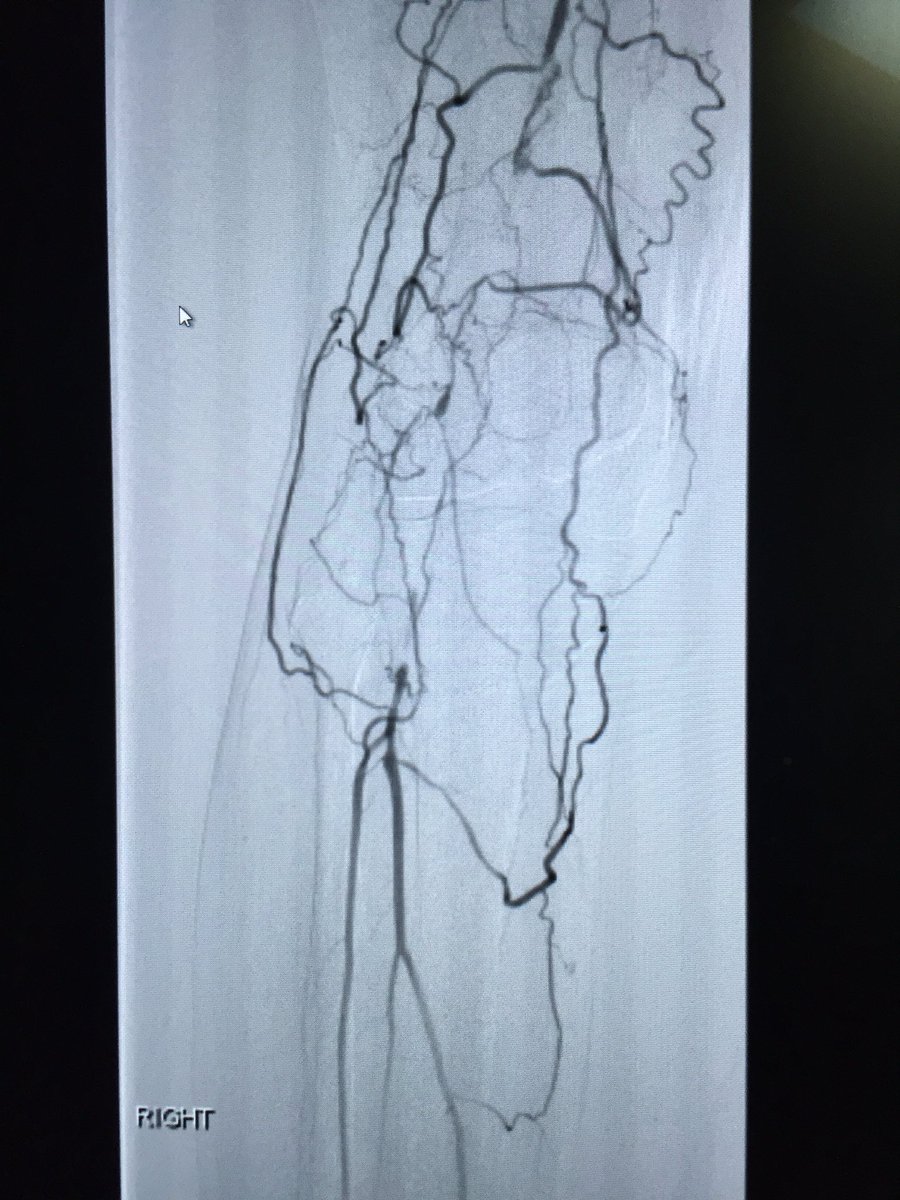 TauqirRana1's tweet photo. popliteal recanalisation and Supera stent saving legs with all the tools. #irad #noamputation #supera #popliteal @Albany_IR @SaherSabri_UVA https://t.co/TWNckrdtkk