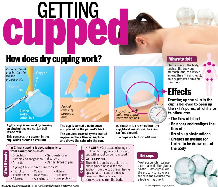Have you tried cupping #miltonON? Online booking available with our Acupuncturist Maria! Only $65 and covered by extended health benefits