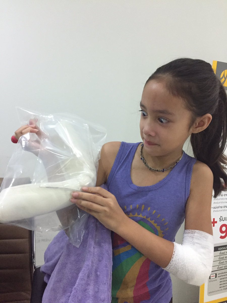LacyRegaspi's tweet photo. Goodbye pins and slab, you won't be missed #RoadToRecovery #nomorebrokenbonesplease #ofcoursewekeptthepins #bravekiddo https://t.co/k16en1RoBG