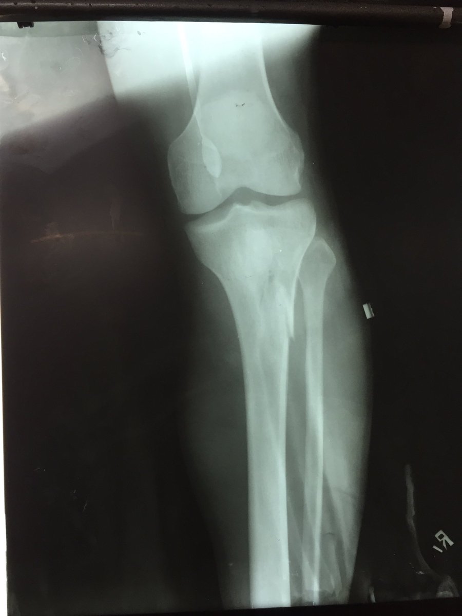 drmanojkrortho1's tweet photo. #GSW rt leg with #comminuted #fracture proximal #tibia with tibial #Tuberosity fracture. https://t.co/R2JiS2BUdi