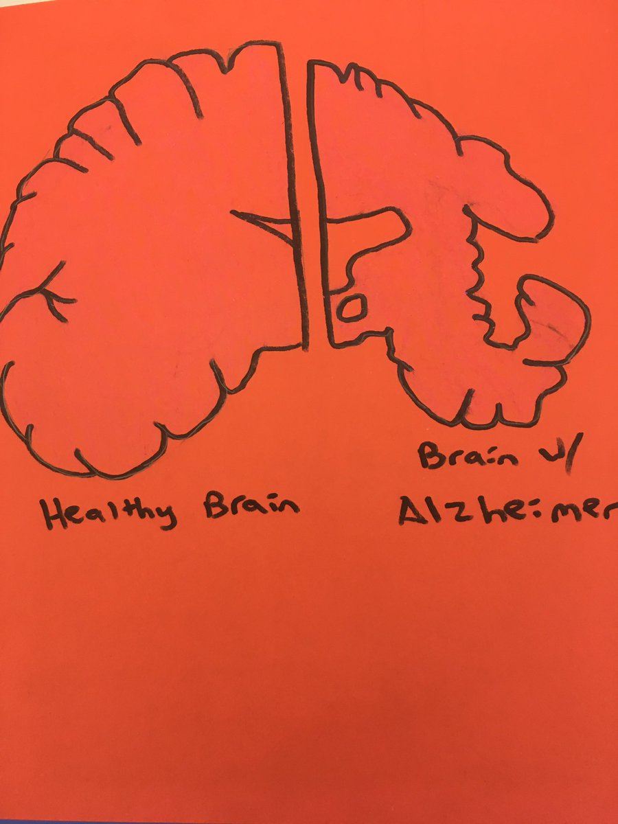 Vote_Nucleus16's tweet photo. Brain with Alzheimer's and the shape and form of the Golgi Apparatus are similar. Just a reminder of what it can do. #cellection16 https://t.co/CQS3uPAgyp