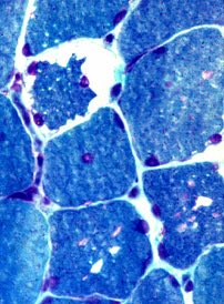 gmitochondria16's tweet photo. a malfunction with the vacuole can cause Danon disease this causes increases autophagic vacuoles and early death KH https://t.co/INscmuct8i https://t.co/EBi89W7GQM