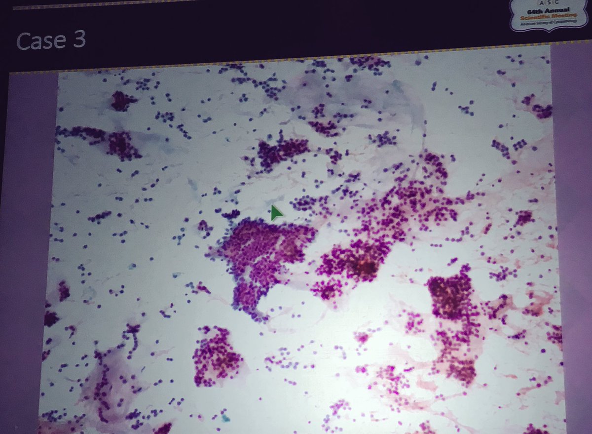 RoseannIWu's tweet photo. Case 3 #ASC2016 Dx Seminar #ASCyto2016 @cytopathology: Metastatic extraskeletal myxoid chondrosarcoma to pancreas (so hard w/out hx!) https://t.co/Ph1UWDyZwZ