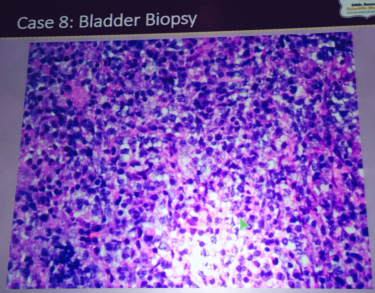 RoseannIWu's tweet photo. Case 8 #ASC2016 Dx Seminar: PTLD DLBCL #ASCyto2016 @cytopathology #Hemepath #Cytopath Great, challenging cases!!! π± https://t.co/xkx06cVM53