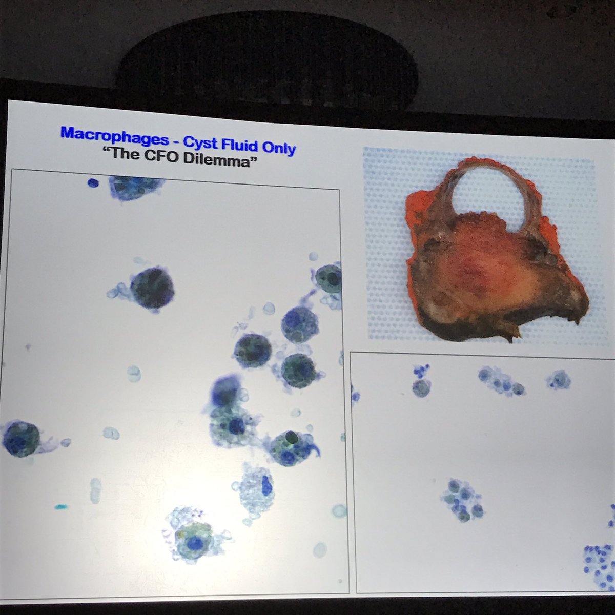 marenwhymd's tweet photo. Most contentious in thyroid FNA: "cyst fluid only" does have some risk of cystic PTC, most call unsat -Dr Ali #ASCyto16  #ASC2016 #cytopath https://t.co/7Af24ZhQek