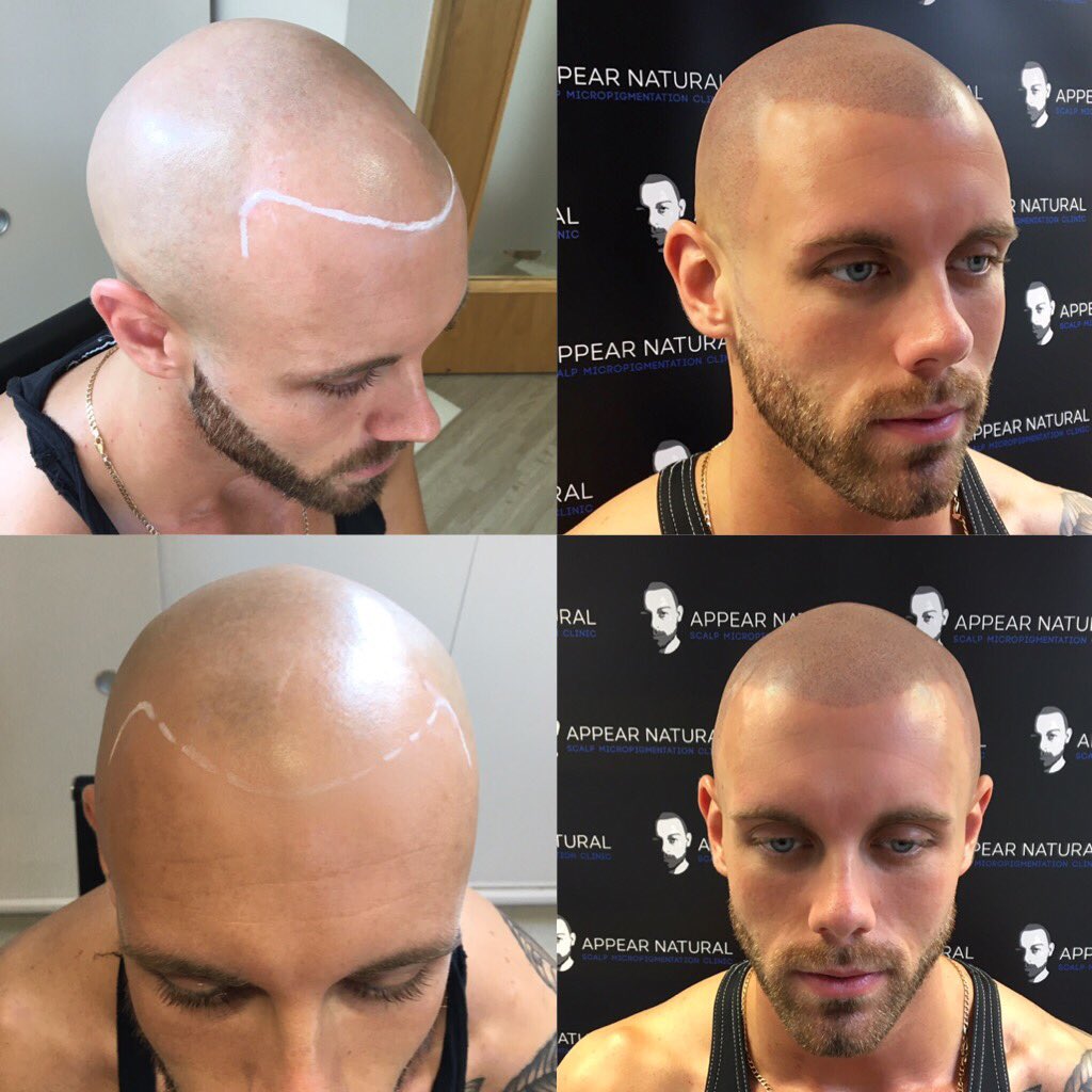 AppearN's tweet photo. Learn more about our amazing hair loss solution! Call us on 02037222338 @BeckBromFL @WoW_Bromley @Bromley_UK_News @bromleyfl @karmastudios https://t.co/P0oF6iOuTk