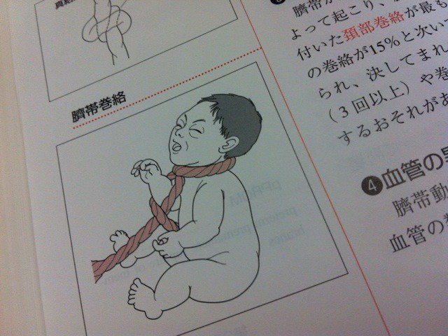 わび さび 君枝の病弱 臍帯巻絡とは べっぴんさん 臍帯巻絡 さいたいけんらく へその緒 が胎児に巻き付くこと 巻き付く場所によって障害のリスクになる 赤ちゃんはへその緒 臍帯 から酸素や栄養を受け取る 君枝の場合は首なので 頸部巻絡 わび さび 君枝の病弱 臍帯巻絡とは べっぴんさん 臍帯巻絡 さいたいけんらく へその緒 が胎児に巻き付くこと 巻き付く場所によって障害のリスクになる 赤ちゃんはへその緒 臍帯 から酸素や栄養を受け取る 君枝の場合は首なので 頸部巻絡