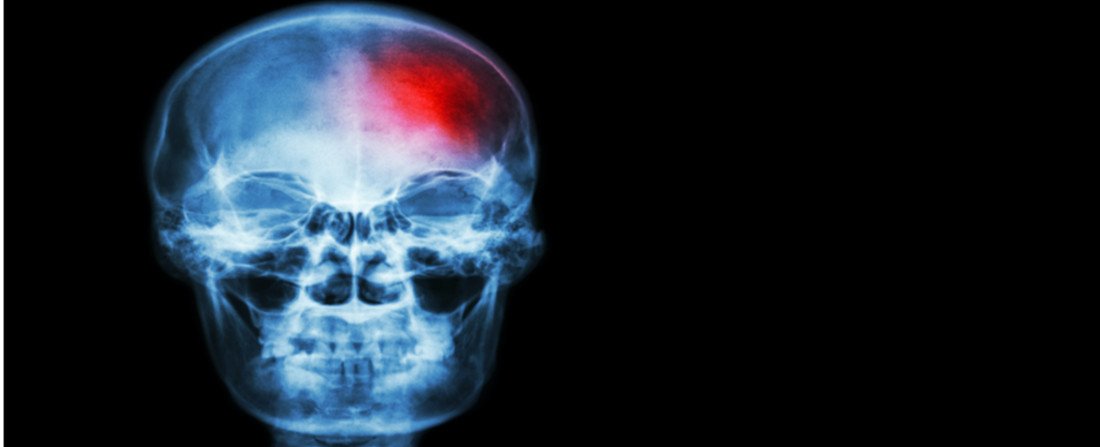 AngloArabHealth's tweet image. The urgent need to improve #strokecare in the #UAE. ow.ly/C5g2305Vf8L #UAEHealth