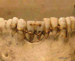 هذه أول عملية جراحية للفك والأسنان أجريت في عصر الفراعنه عمرها أكثر من 4000 عام ووجدت في أحد المومياوات