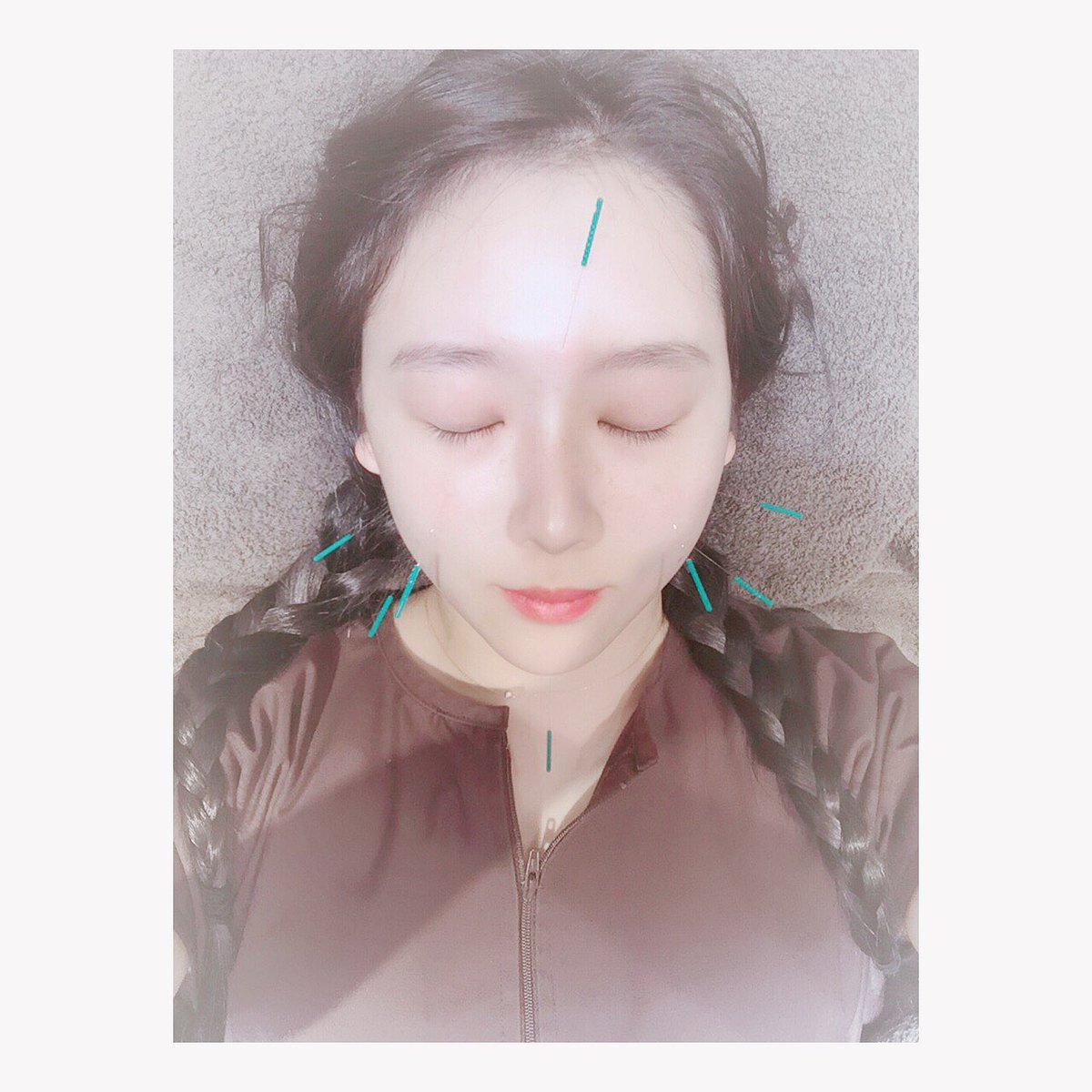 yulayula8's tweet photo. 先日、
イセアクリニックさんで
初の美容鍼をしていただきました！

痛くないのにすっきりびっくり… https://t.co/qUnaMDKusU